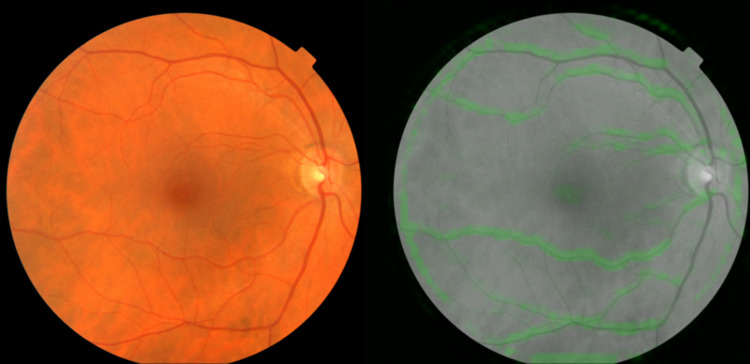 Google's Retinal Scans